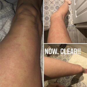 TSW red skin syndrome legs before and after 